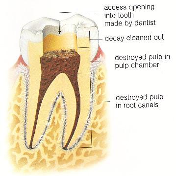 Phase 2: 1 st visit commencement of Root Canal Therapy At this visit, the tooth