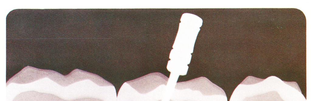 gained to the root canal space through a small opening on the top of the tooth.