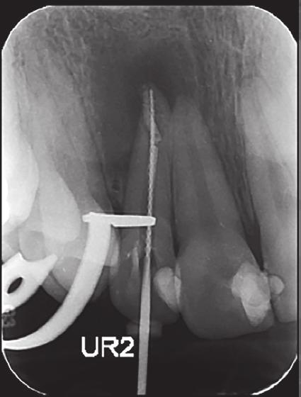 This will involve a review of eight cases treated using this material, including a mixture of open apices, resorption defects and