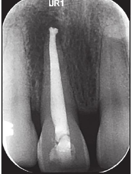 Preoperative radiographs confirmed the presence of an open apex and a periapical radiolucency (Figure 1a).