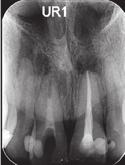 35-year-old male attended with chronic periapical periodontitis, affecting his LR1 and