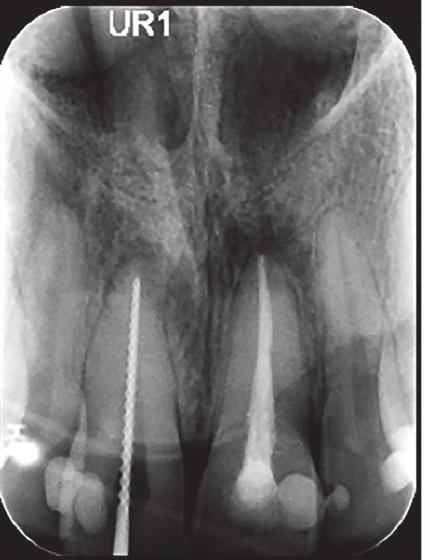 In light of the good quality endodontic treatment already provided it was decided to