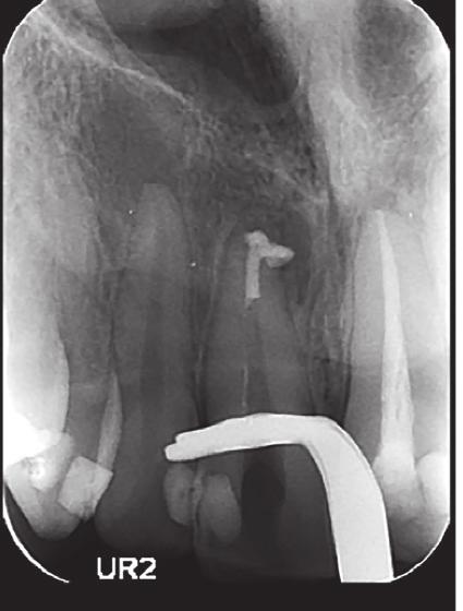 The radiograph confirms the presence of a wellsealed 2mm apical in both canals (Figure
