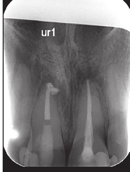 periapical periodontitis, affecting his root canal treated and post-crown UL1 (Figure 3a).