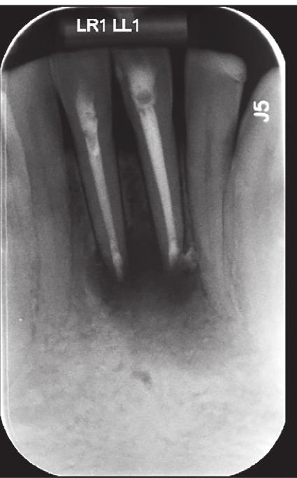 Figure 5d: Case five Case five: open apex apical obturation UR1 A 24-year-old male