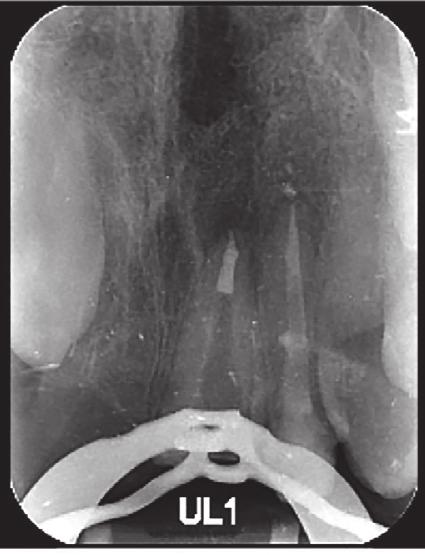 UR1. Clinically, the master apical file was 80K at a of 20.5mm.
