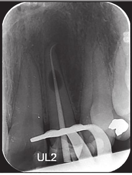 The radiographic result confirmed a wellobturated root canal system/ defect