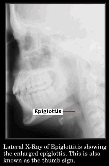 Acute Epiglottitis Calm environment