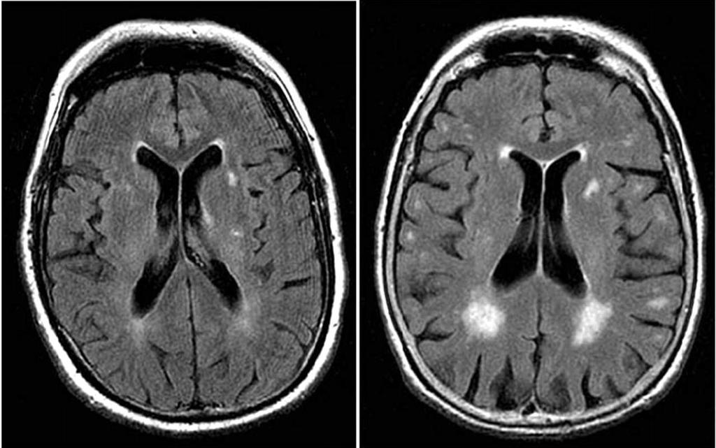 Cerebral small vessel disease What is it? What are the clinical syndromes?