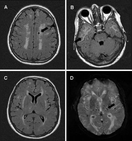 Genetic causes of hereditary small vessel disease Cerebral small vessel disease is considered hereditary in about 5% of patients and is characterized by lacunar infarcts and white matter