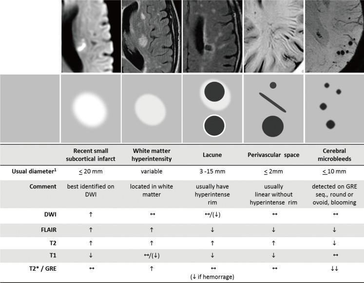 Radiological markers of small vessel disease main difference between symptomatic and silent cerebral infarcts are their size and