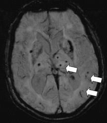 Cerebral Microbleeds CMBs are small (2 to 5 mm) hypointense lesions on paramagnetic sensitive MR sequences such as T2 * -weighted gradientecho (GRE) or susceptibility-weighted sequences.