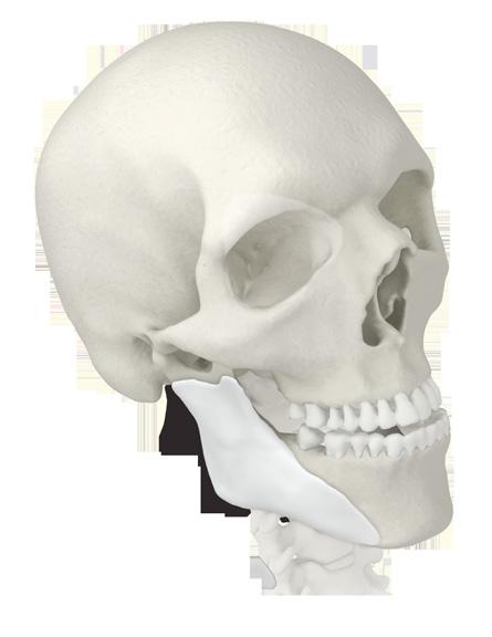The host bone model is provided as a preoperative guide to