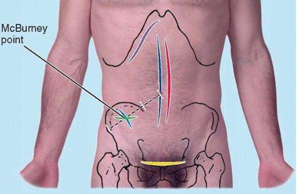 Organs in the infracolic compartment Vermiform appendix - projections: McBurney point