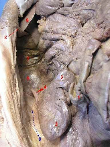 Peritoneal spaces in the infracolic compartment Right paracolic gutter Left paracolic