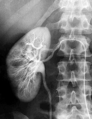 Primary retroperitoneal structures The kidneys are bean-shaped structures located between the T12 and the