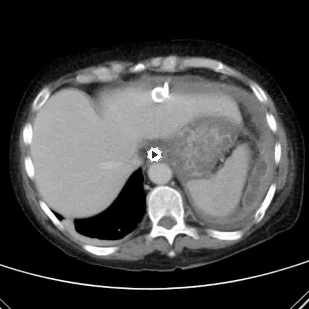 Fig.: Axial CT demonstrating peripancreatic collections involving the lesser sac, left anterior pararenal space, mesenteric root and transverse mesocolon. References: R.