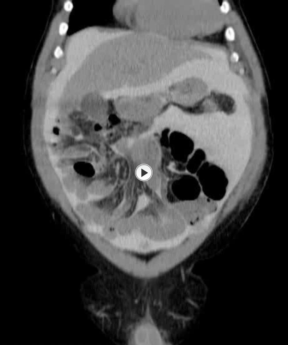 Fig.: Coronal CT peritoneogram demonstrating peritoneal spaces.
