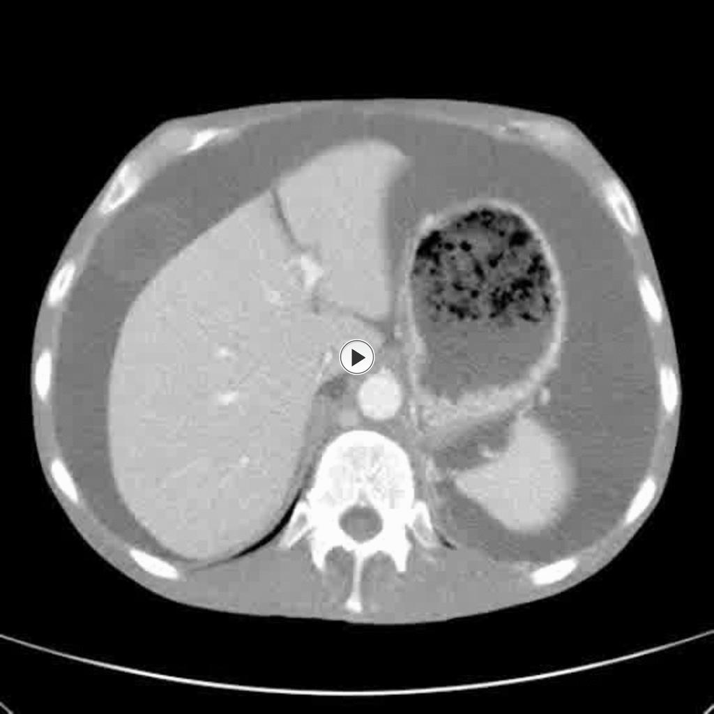 Fig.: Coronal CT demonstrating malignant ascites within all the intraperitoneal spaces. References: R.