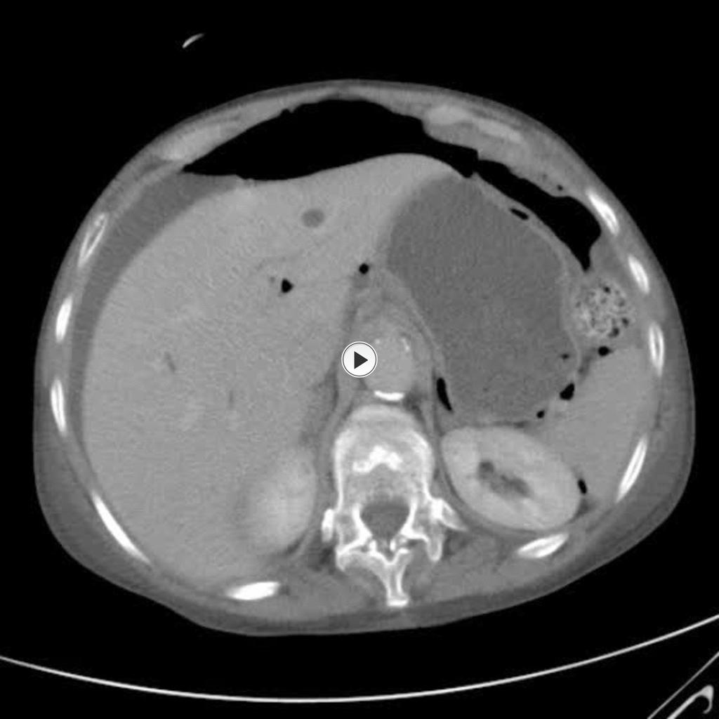 Fig.: Coronal CT demonstrating the distribution of free gas following a perforated duodenal ulcer. References: R.