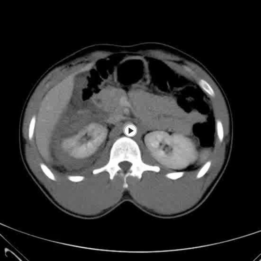 Fig.: Coronal CT demonstrating retroperitoneal bleed from right kidney following trauma. 25 year old man kicked by a horse. References: R.