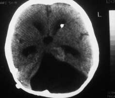 350 Fig. 1 NCCT (head) of a child showing the decreased size of lateral ventricles but a persistent posterior fossa cyst although a wellfunctioning ventriculoperitoneal shunt is in place Fig.