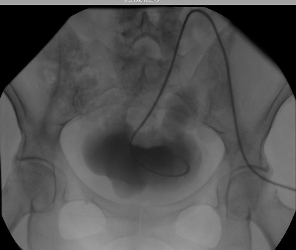 tunnel or peritoneal entry site, and to confirm the proper location of the curled distal tip within the pelvic portion of the peritoneal cavity.