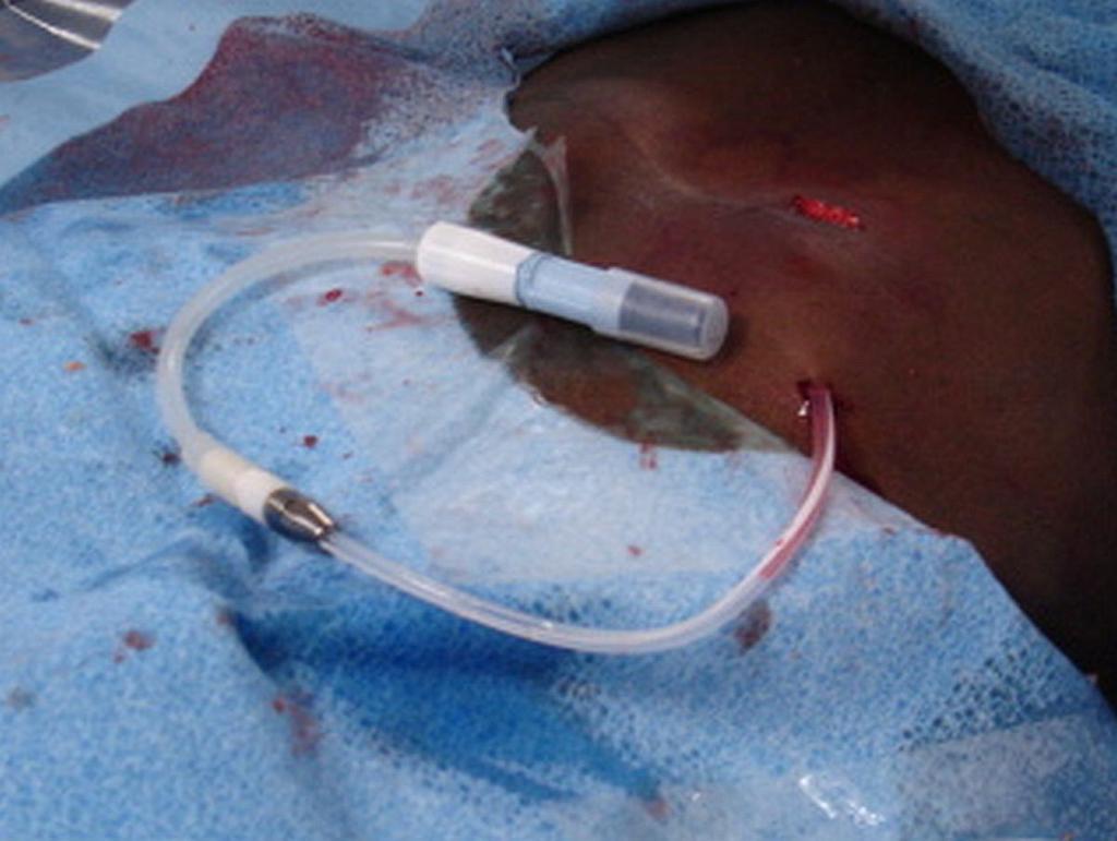 A portion of the infused normal saline might be retained in the peritoneal cavity because of the patient s recumbent position, with pooling of fluid in the deep pelvic gutter.