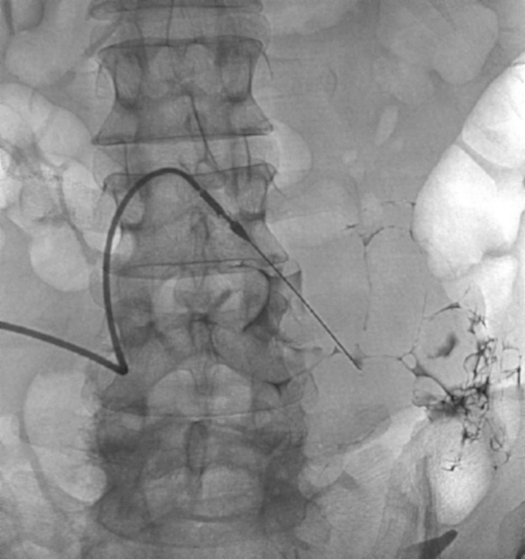 Dilatation should occur under fluoroscopic visualization, and the dilators should be directed caudally toward the pelvic cavity in the same direction as the original needlestick so as to avoid the