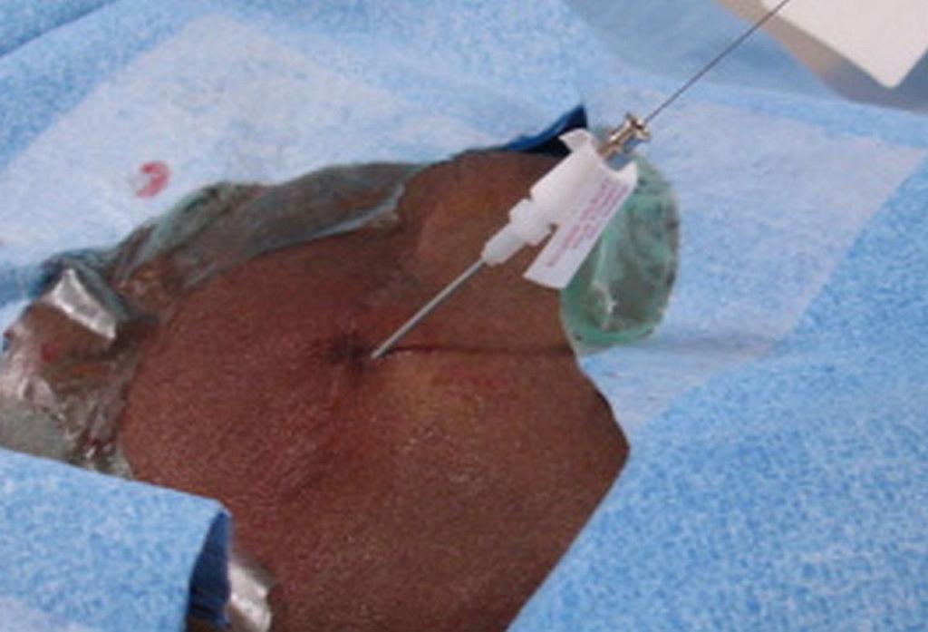 018-inch nitinol wire is threaded through the introducer needle into the peritoneal cavity.
