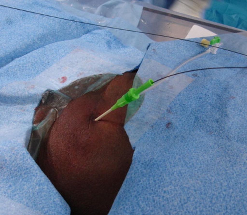 TX, USA) (10). Care should be taken to ensure that the suture needle does not puncture the catheter.