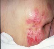 Moisture Lesions Incontinent Associated Dermatitis Superficial moist lesions with irregular borders