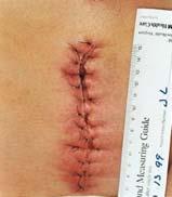 Wound Deterioration Local signs Pain develops or increases Edema develops Poor quality/ color