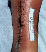 ) erythema or induration Systemic Symptoms Fever Malaise Elevated blood glucose in DM Flu-like