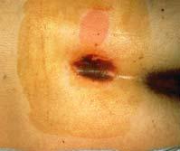 Pressure Ulcers Localized injury to skin and/or