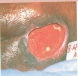 dermatitis (IAD), maceration or excoriation Stage III Stage III Full thickness skin loss Bone,