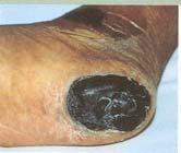 Unstagable Full thickness tissue loss which the base of the ulcer is covered with slough (yellow, tan, gray, green or brown) and/or eschar (tan, brown or