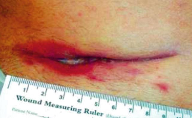 9 cm deep. The wound was dressed with gauze dressings. The dressings were changed twice weekly. Pressure level set at -80 mm Hg.