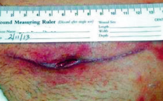 5 cm in depth after 2 weeks of. The wound is considered healed and it is decided to stop the negative pressure wound.