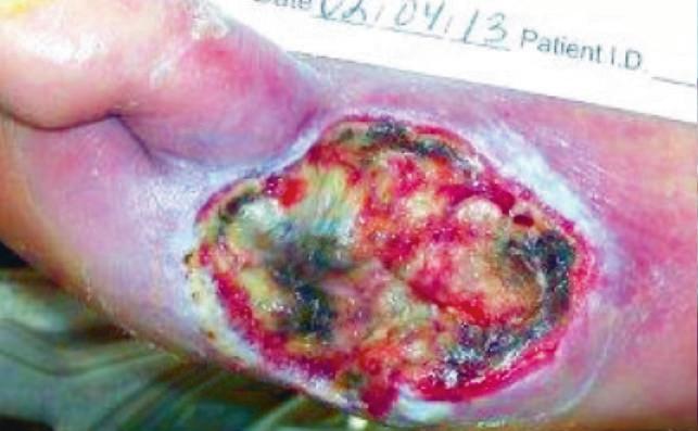 the foot. Previously treated with iodine impregnated gauze. The wound is 4.8 cm in length, 3.6 cm in width with moderate exudate levels.