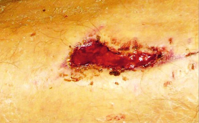 Wound further treated with advanced wound dressings.