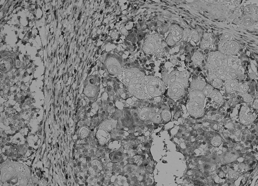 Immunohistochemical staining revealed that Ki-67 was strongly express ed in the epithelial cells with a positive expression rate of 61.8% (Fig. 3D).