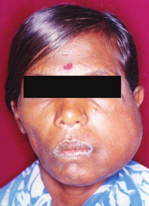 An Unusual Case of Ameloblastoma arising from Dentigerous Cyst solitary diffuse swelling, irregularly shaped, measuring 8 10 cm in size with ill-defined margins, was present on the left