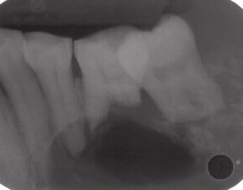 Anil K Nagarajappa et al Fig. 5: An intraoral periapical radiograph showing a large multilocular radiolucency Fig. 6: An intraoral periapical radiograph showing a typical soap bubble appearance Fig.