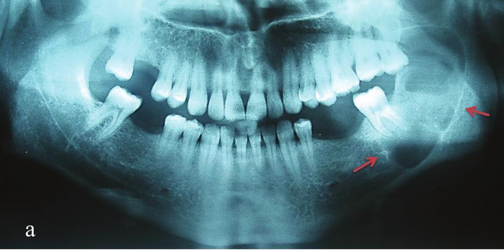 The radiological examination revealed a unilocular radiolucent lesion with well-defined sclerotic margins, including lower second molar tooth in it and it extended up to the mandibular notch.