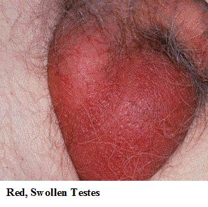 #3 continued... O/E T 37.9. P - 92. Pt appears uncomfortable, swollen, erythematous scrotum.