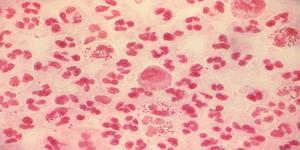 Microbiology Gram staining of urethral smear/ MSU Gram neg diplococci N.