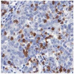 2014 Jun;20(6):607-15 CD95L is expressed by various cell types in the tumor microenvironment thereby protecting tumor