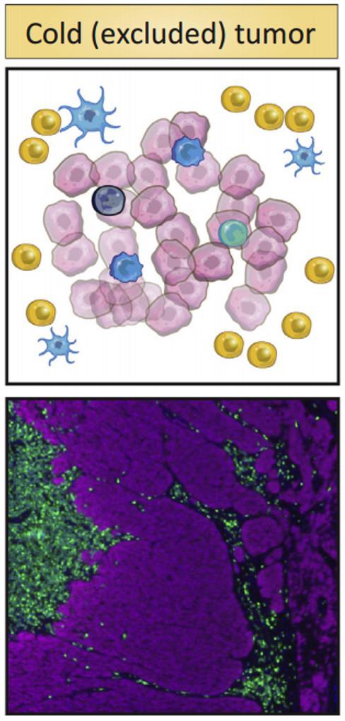 Immunosuppression in Tumor Microenvironment Heterogeneity regarding tumor microenvironment (TME) and immune cell infiltrates in tumors is observed The pre-existing immune landscape within the TME