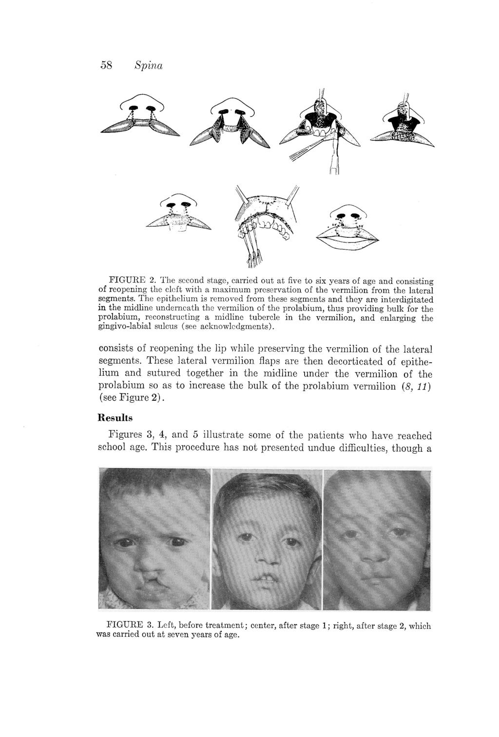 FIGURE 2. The second stage, carried out at five to six years of age and consisting of reopening the cleft with a maximum preservation of the vermilion from the lateral segments.